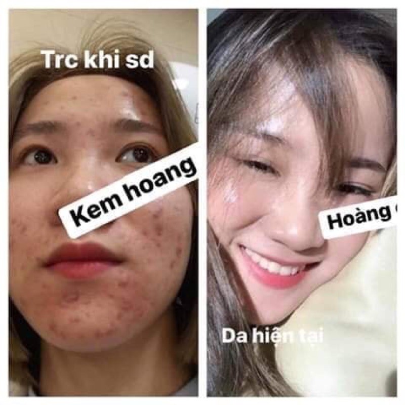 Kem Ngày Hoàng Cung Hồng Lẻ