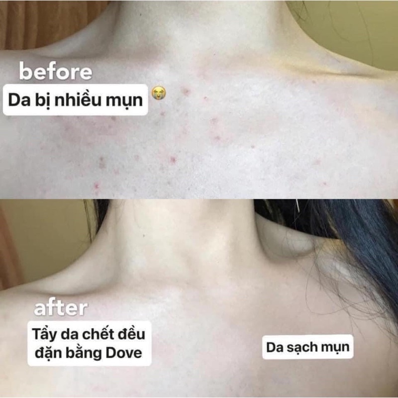 Kem Tẩy Da Chết Body Dove - Tẩy Tế Bào Chết Toàn Thân Trắng Mịn