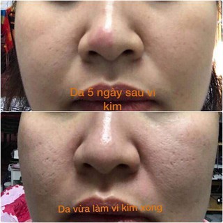 Vi kim tảo biển Utral V( lẻ theo cặp)