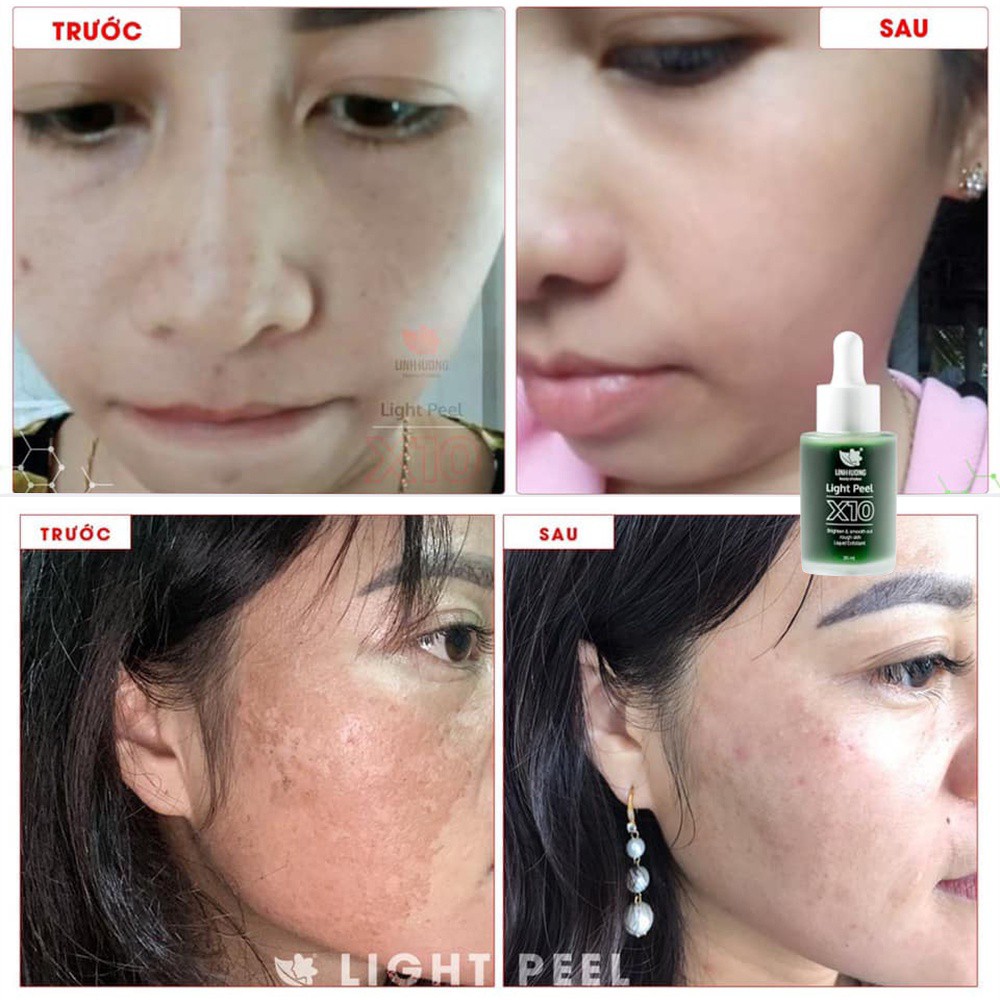 Thay Da Sinh Học Linh Hương, Peel Da,  Light Peel X10 làm trắng da, tái tạo làn da mới, thay da tại nhà