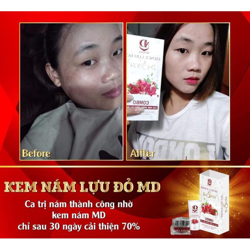 Kem Face Nám Lựu Đỏ MD Beauty