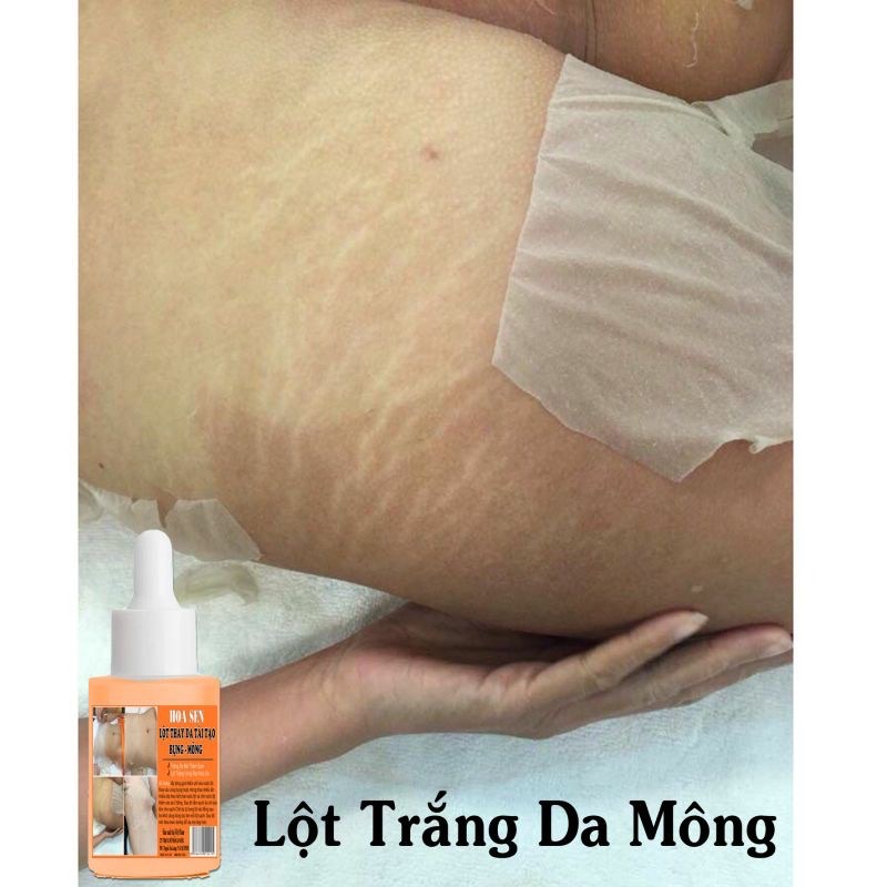 Thay Da Sinh Học Lột Mông Bụng Hết Thâm Rạn Da | BigBuy360 - bigbuy360.vn