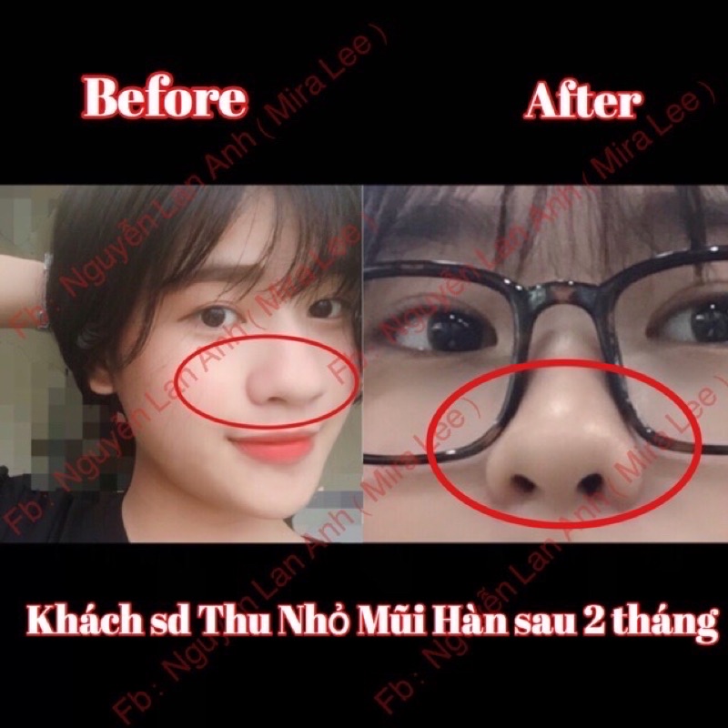 Tinh chất Miracle Pháp thu nhỏ cánh mũi, hiệu quả chỉ sau 14 ngày