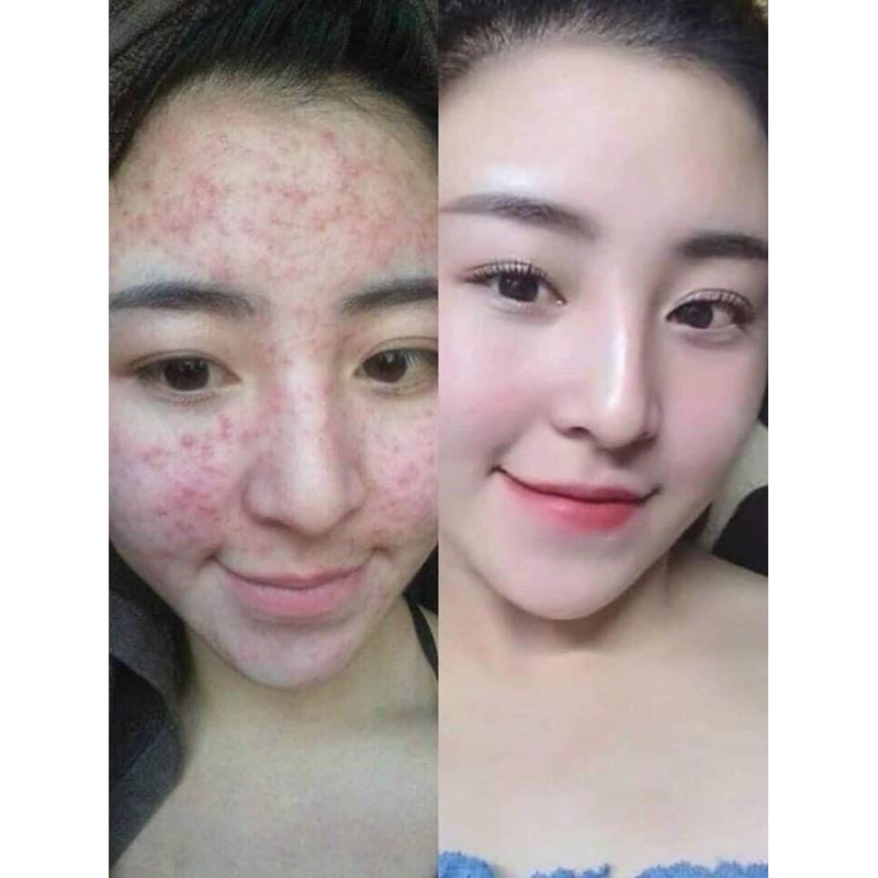 Kem Dưỡng Ngừa Mụn Kracie Nhật Bản Hadabisei Facial Cream 50g Dưỡng Trắng Da Dành Cho Da Dầu Mụn