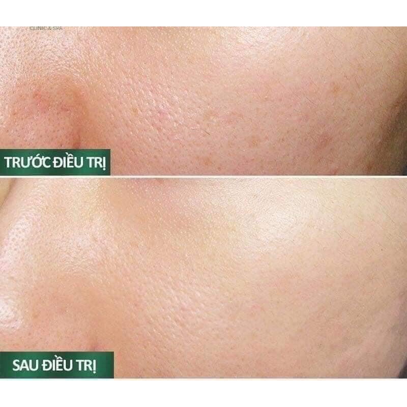 Kem dưỡng se khít chân lông sqs