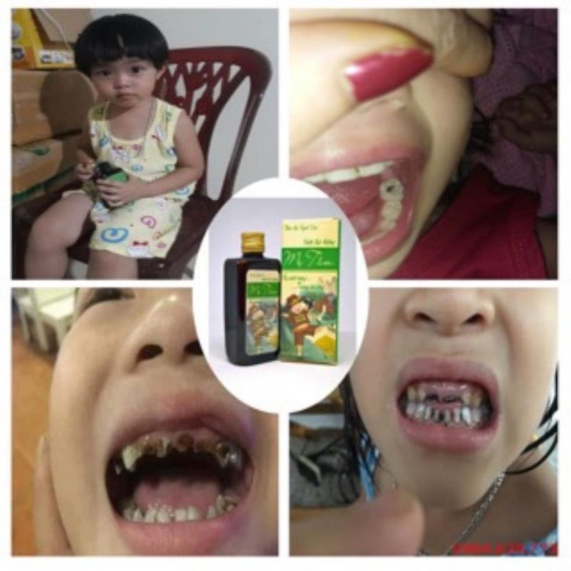 NƯỚC SÚC MIỆNG SÂU RĂNG TRẺ EM THANH MỘC HƯƠNG