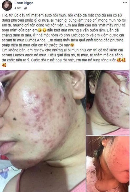 Tinh chất ngăn ngừa mụn Lumos Ance Serum 10ml