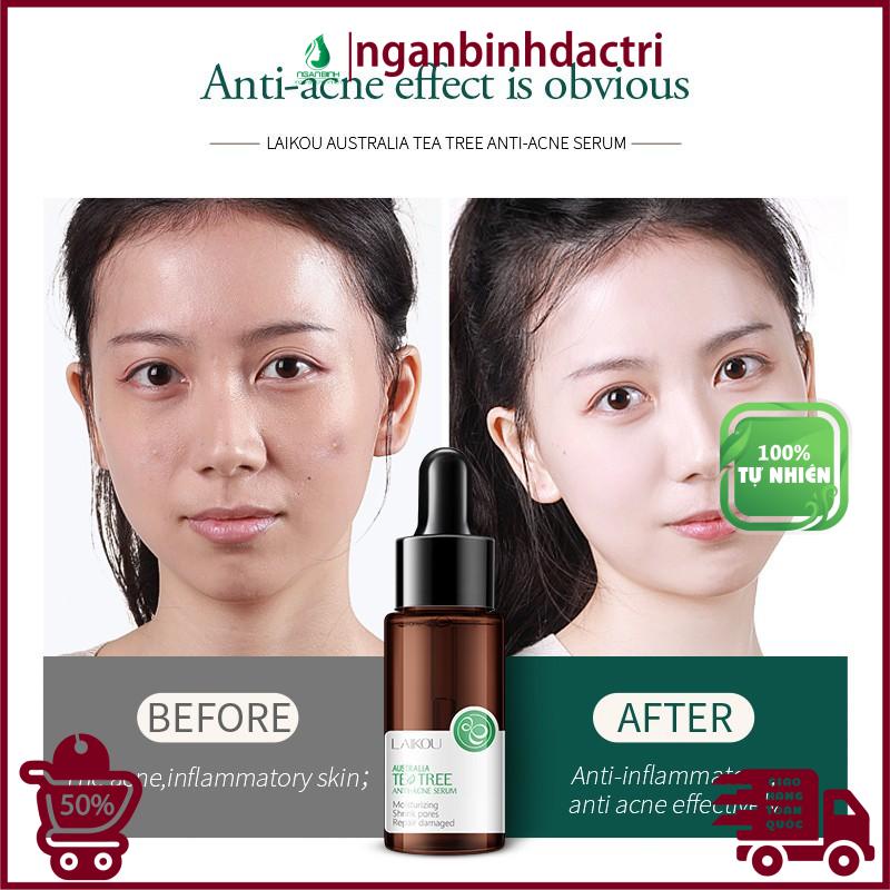 Serum Tràm Trà Úc Mờ Sẹo Mụn Chăm Sóc Da Hiệu Quả mới