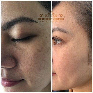 Kem Thâm Nám Tàn Nhang Doctor Queen Melasma Perfect Cream Mẫu Mới