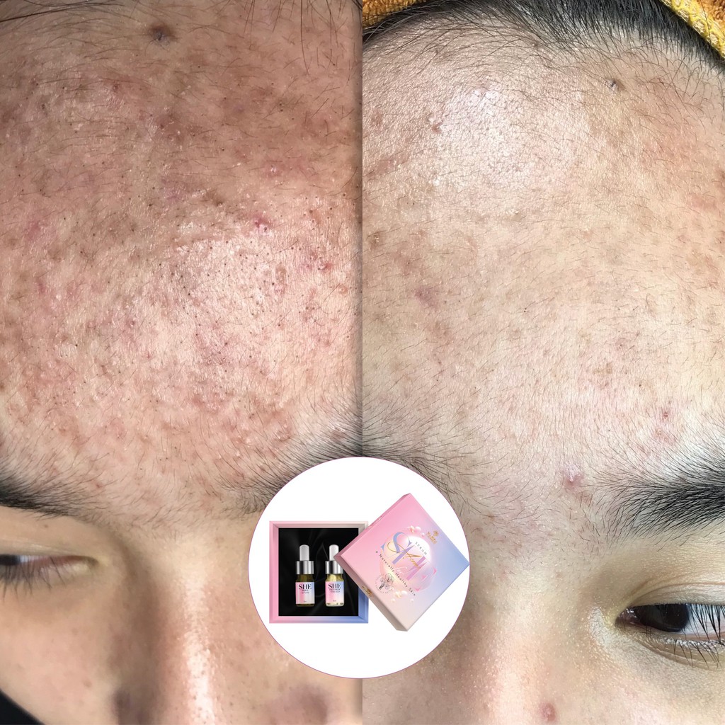 Combo Sạch mụn Skill Acnes 💥FREESHIP💥+ Treatment Collagen - Da khoẻ, Căng bóng, Trắng sáng + Tặng 5 mặt nạ dưỡng ẩm 30K | BigBuy360 - bigbuy360.vn