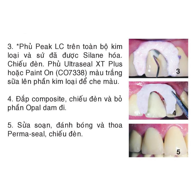 Vật liệu vá, sửa sứ, veneer Etching sứ Pocerlain - Ultradent