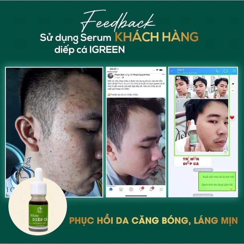 SERUM DIẾP CÁ - GIẢM MỤN, GIẢM THÂM, SE KHÍT LỖ CHÂN LÔNG-SERUM Diếp Cá IGREEN