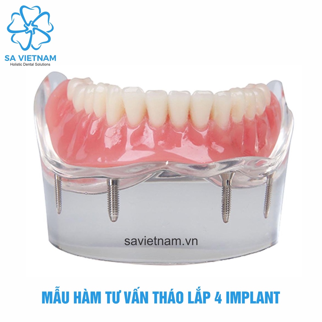 Mẫu tư vấn tháo lắp 2 implant, 4 implant - Hàm tư vấn nha khoa, Mẫu tư vấn nha khoa