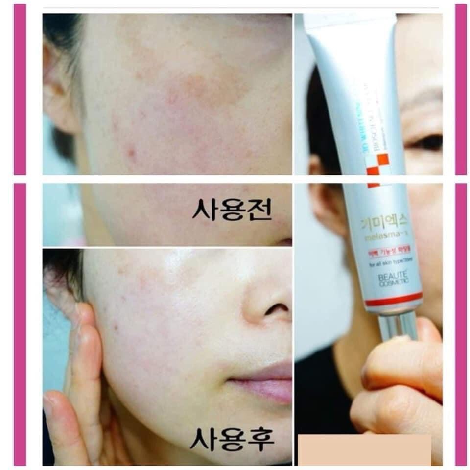 Kem Nám Melasma-X 3D Whitening Clinic Cream