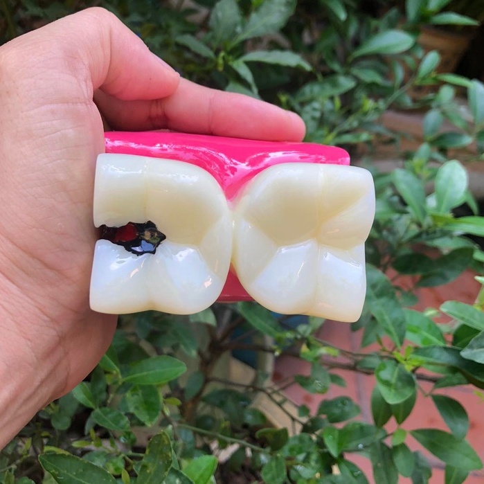 Mô hình nha khoa giải phẫu phóng đại bệnh lý sâu răng,mô hình răng sâu phóng đại x6 lần ,dụng cụ hỗ trợ học nha khoa