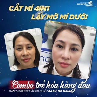 Dịch Vụ Cắt Mí 4 in 1 tại Gangwhoo