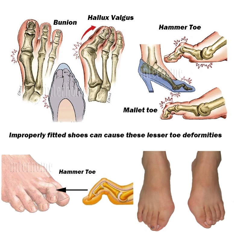 Dụng cụ tách ngón chân để giảm đau tiện lợi