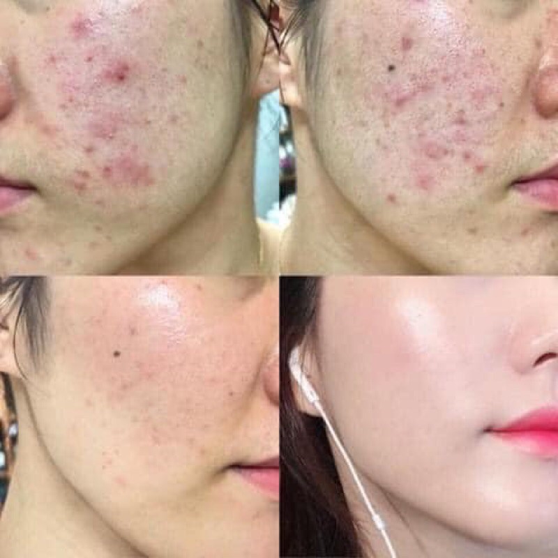 SERUM GIẢM THÂM MỤN THE ORDINARY NIACINAMIDE 10% + ZIN 1%