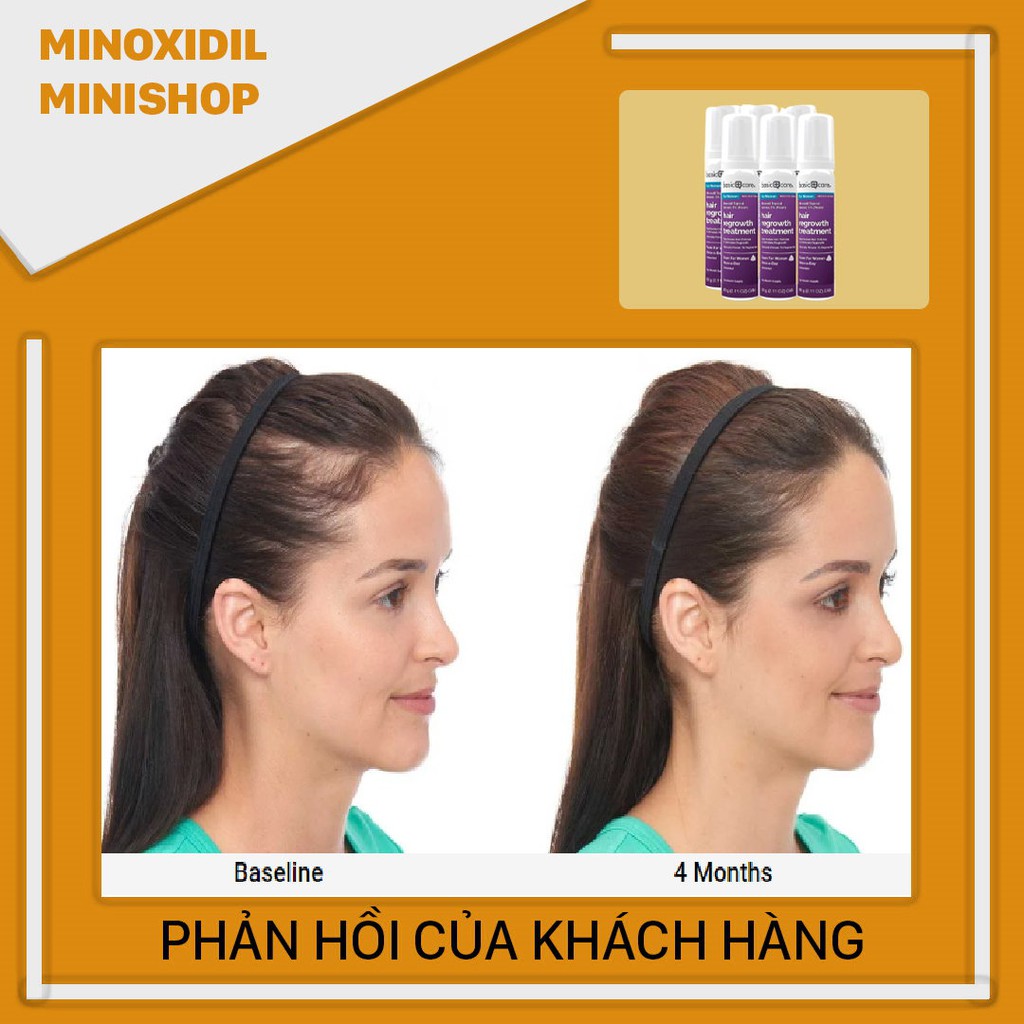 Dung Dịch Mọc Tóc - Mọc Lông Vùng Kín Nữ Minoxidil Basic Care 5% Dạng Bọt