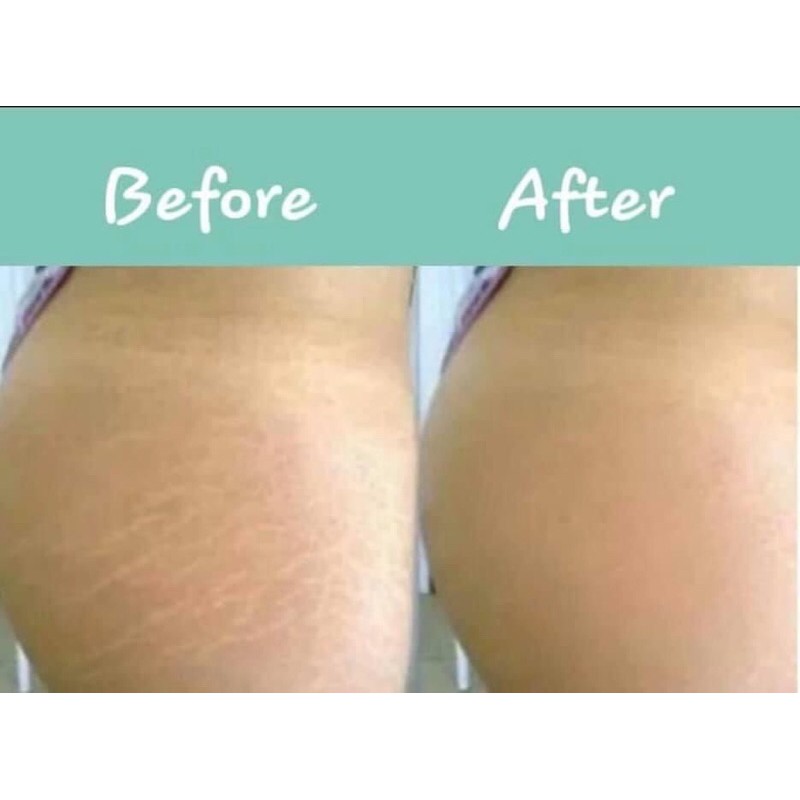 Kem trị rạn Stretcheal ( có bill đầy đủ từ nhà sản xuất) | BigBuy360 - bigbuy360.vn