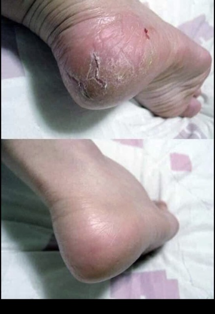 ( CHÍNH HÃNG) Kem Trị Nứt Nẻ Gót Chân ZIAJA FOOT Cream Cracked Skin 60ml
