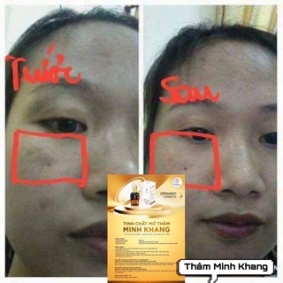 Tinh Chất Mờ Thâm Phúc Minh Khang