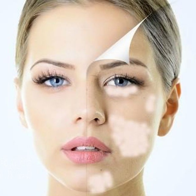 Đèn chiếu bệnh bạch biến, vẩy nến,viêm da