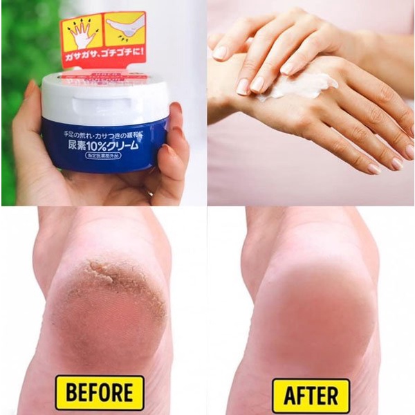 Kem nứt nẻ gót chân shiseido urea cream nhật bản làm hết nứt nẻ gót chân tay đầu gối loại bỏ làn da chai lì thô giáp