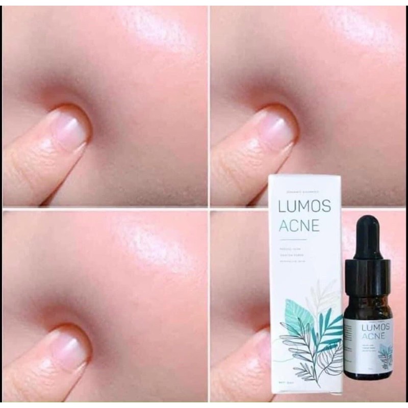 SERUM THẢO DƯƠC LUMOS ACNE MẪU MỚI 2021