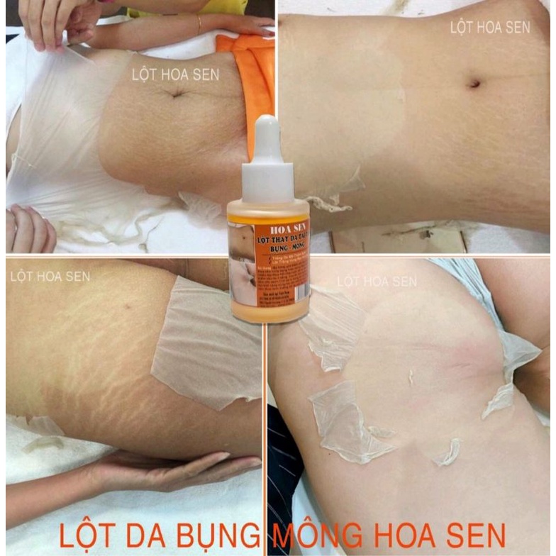 LỘT THAY DA MÔNG.HẾT THẰM MỜ RẠN.NỨT DA