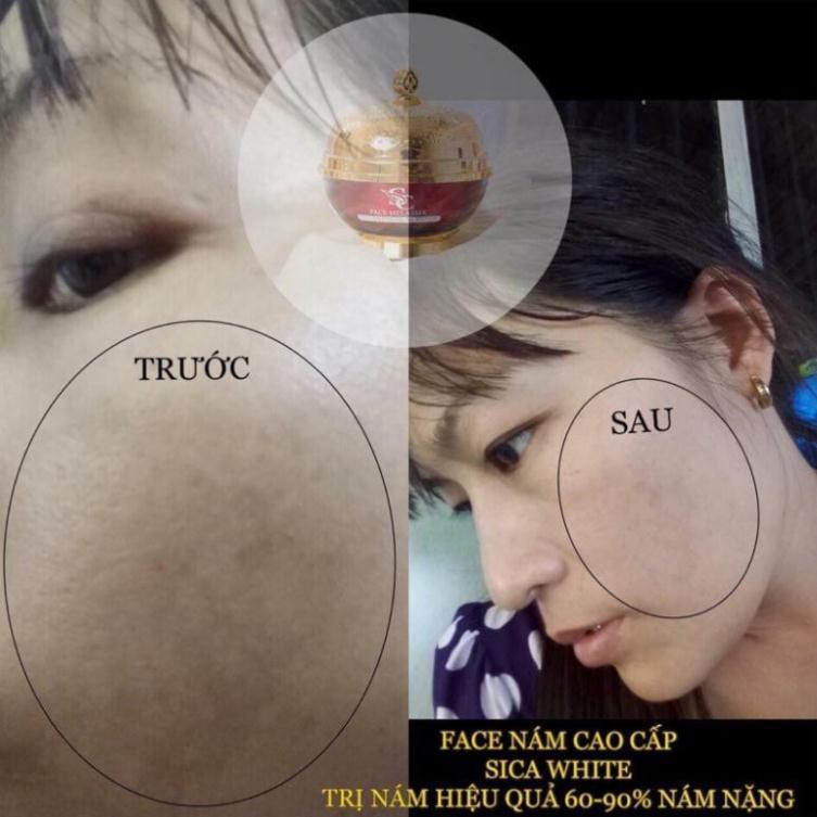 Face Melasma - Kem Nám Vip