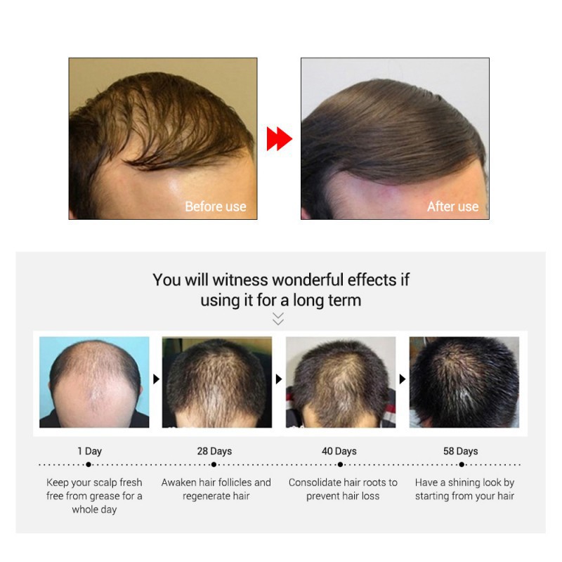 Tinh dầu kích thích mọc tóc nuôi dưỡng da đầu 20ml tiện dụng