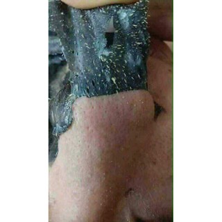 COMBO GEL lột mụn Lê Thanh