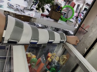 Nẹp bắp tay,cánh tay dài