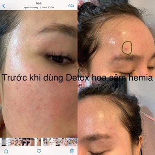Detox mụn Hoa Sâm Hemia