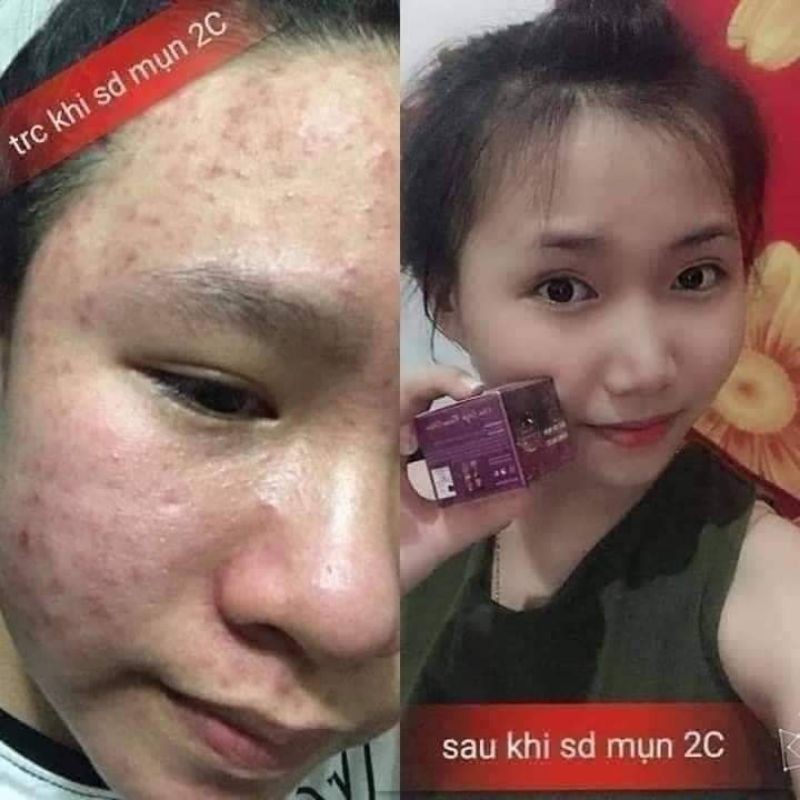 Kem mụn 2C | BigBuy360 - bigbuy360.vn