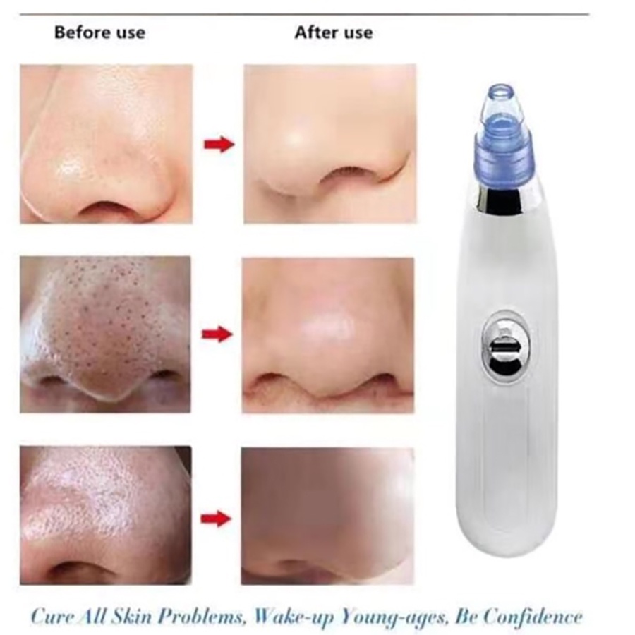 Máy Hút Mụn Đầu Đen Làm Sạch Lỗ Chân Lông Hiệu Quả