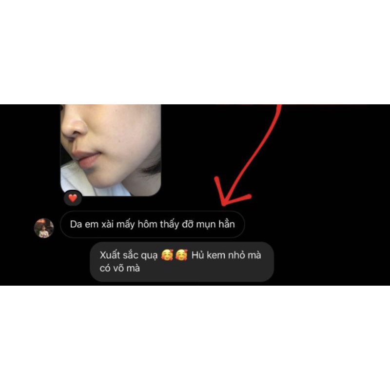 KEM NỌC ONG CHẤM MỤN, CHĂM SÓC DA MỤN, THÂM SAU MỤN | BigBuy360 - bigbuy360.vn