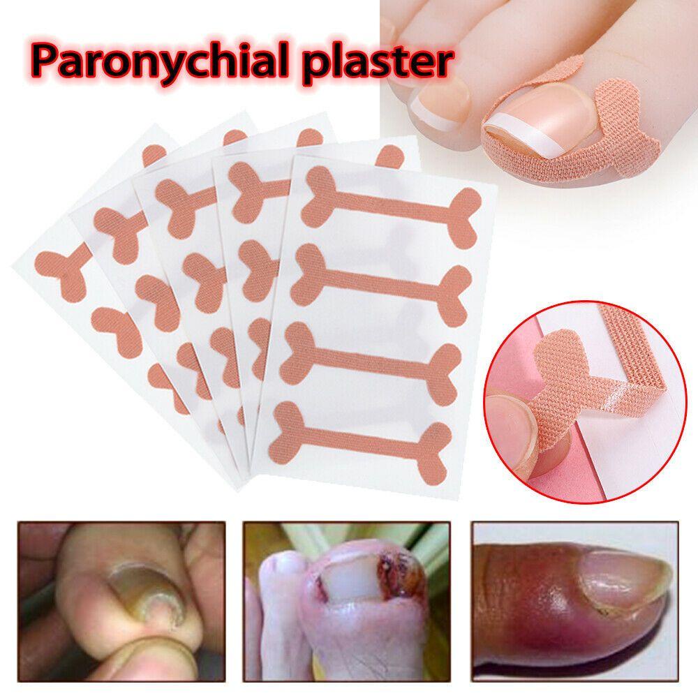 Miếng Dán Điều Chỉnh Móng Chân Mọc Ngược Tiện Dụng