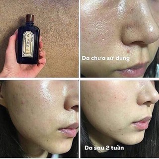 Nước hoa hồng da mụn Bingansui Nhật