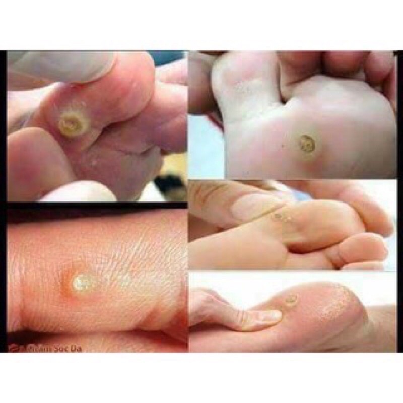 Miếng dán mụn cóc, mụn cơm, mắt cá chân, vết chai chân, cồi cá,… cam kết hiệu quả
