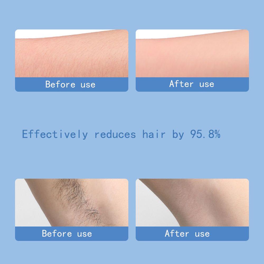 Máy Tẩy Lông Thanh Lịch Trẻ Hóa Làn Da Dễ Sử Dụng