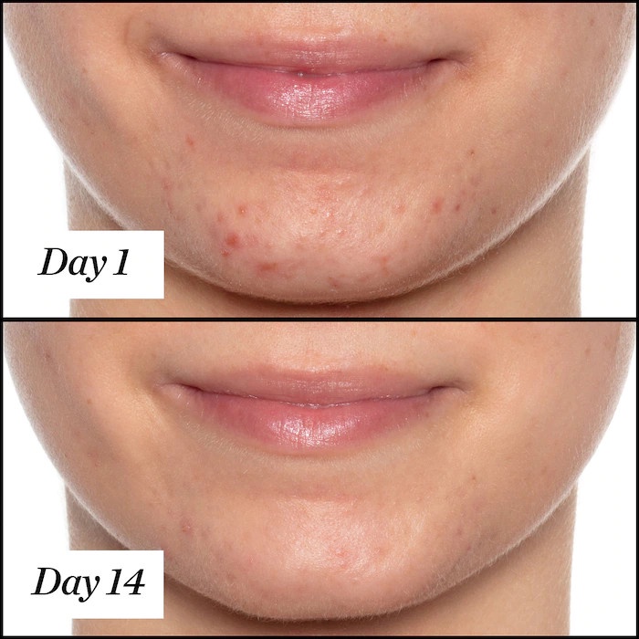 Dầu dưỡng cho da dầu mụn Sunday Riley U.F.O. Salicylic Acid BHA Acne Treatment Face Oil