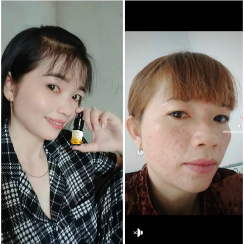Serum giảm mụn mờ thâm Dr skinbeauty, Ngăn ngừa mụn, Mờ thâm, Phục hồi da