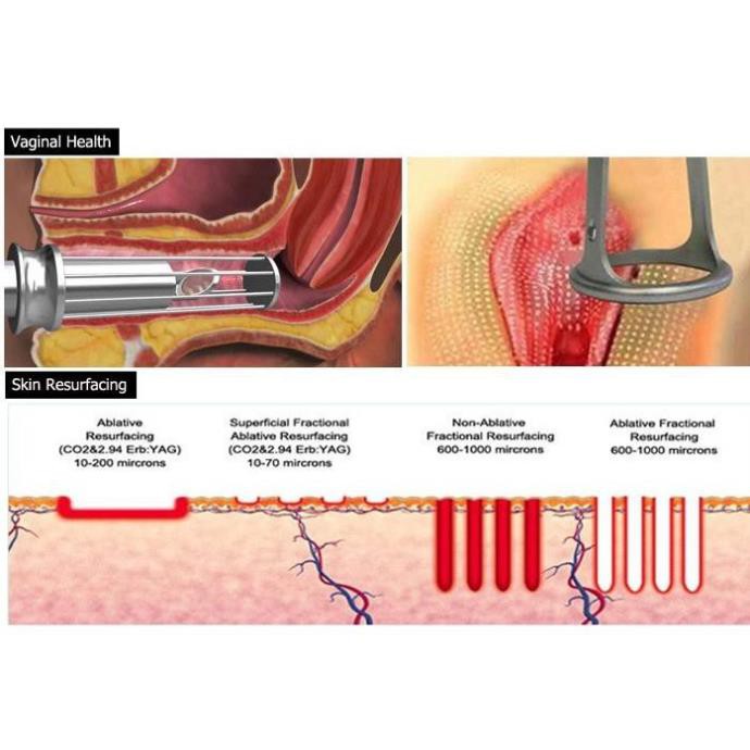 MÁY LASER FRACTIONAL CO2