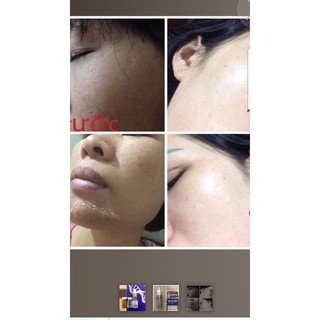 [tách lẻ 1 cặp] Vi kim tảo Ronas