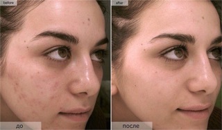 The Ordinary AHA 30% + BHA 2% Peeling Solution hàng hot
