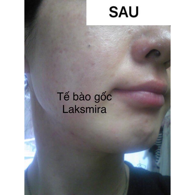 Tế bào gốc laksmira chính hãng