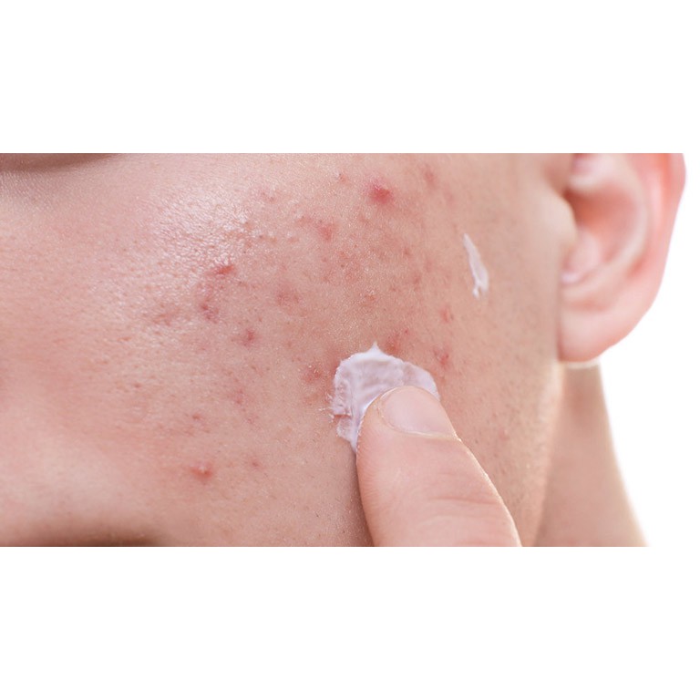 Gel Giảm Ngừa Mụn Derma Forte 15G | BigBuy360 - bigbuy360.vn