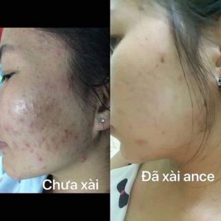 3 hũ nhỏ kem mụn